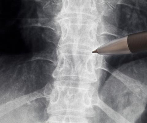 Wskazywanie długopisem na prześwietlenie kręgosłupa