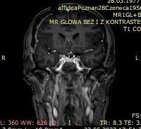 zdjecie-11-pooperacyjne-w-paszczyznie-czoowej--guz-usuniety-w-centrumzgowa-